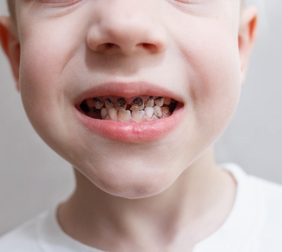 Close up of child smiling with decayed teeth