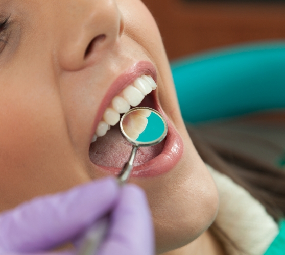 Close up of dental patient with dental mirror in their mouth