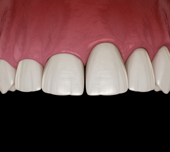 Illustrated mouth with uneven gumline