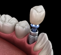 Illustrated dental crown being placed onto a dental implant