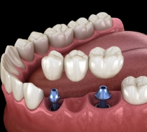 Illustrated dental bridge being placed onto three dental implants