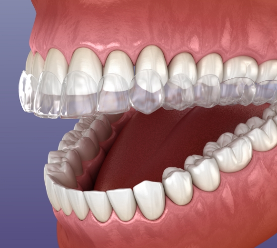 Illustrated Invisalign aligner being placed over upper arch of teeth