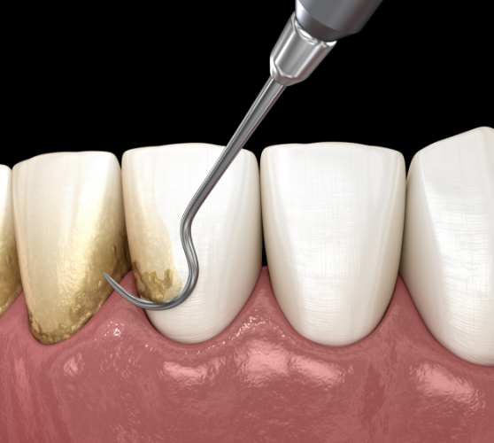 Illustrated dental scaler removing plaque buildup from gumline