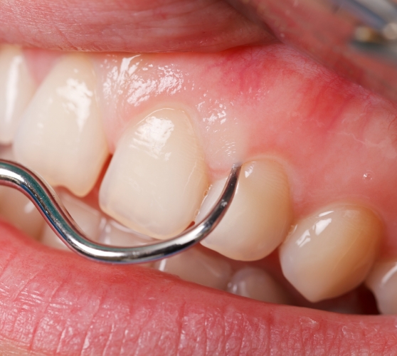 Close up of dental instrument treating the gums