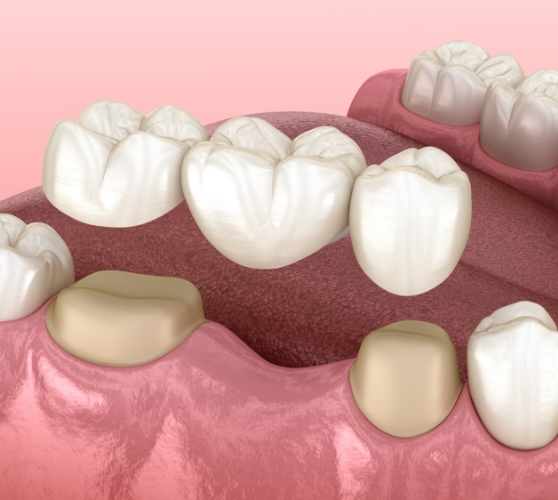 Illustrated dental bridge replacing a missing tooth