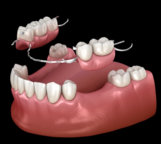 Illustrated partial denture being placed to replace a few missing teeth