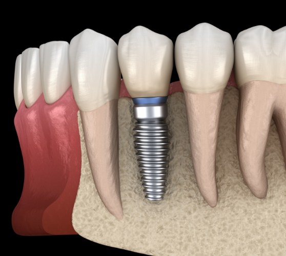 Illustrated dental implant in jawbone replacing lower tooth